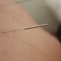 דיקור סיני למחלות עיניים בגיל השלישי