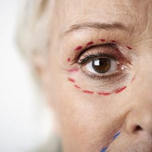 מתיחת פנים אחרי גיל 60 בהרדמה מקומית