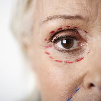 הרמת עפעפיים ללא ניתוח למבוגרות