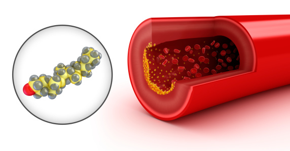 סובלים מפקקת ורידים? כיום יש פתרון לתופעה!