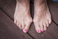 טיפולים בציפורן חודרנית בגיל השלישי